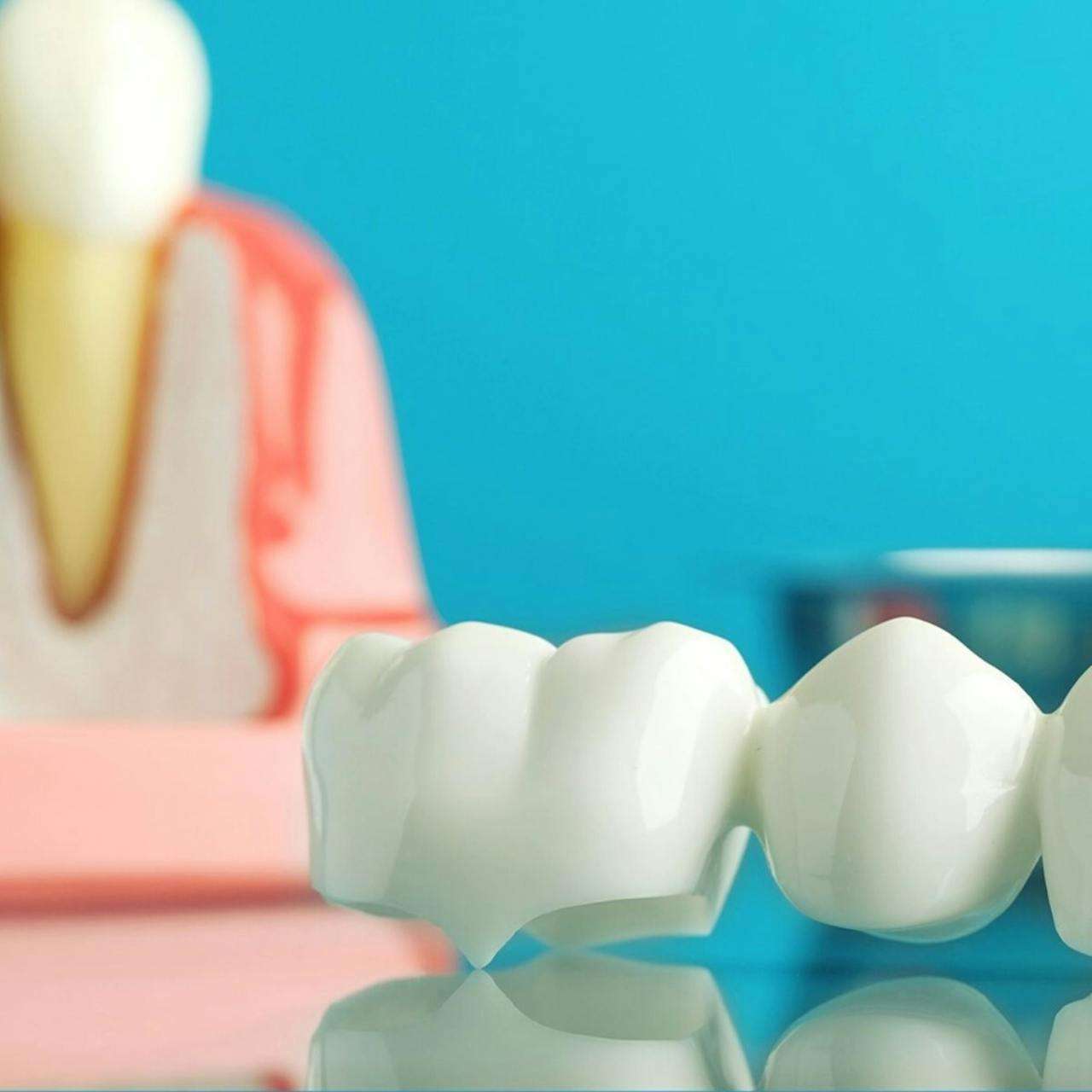 can a dental bridge be recemented